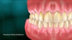 Whitening With Bleaching Tray 001