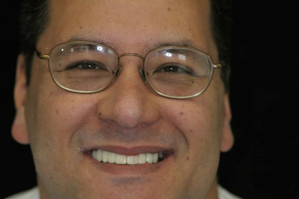 Rasner Smile gallery after 17