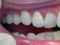 Implants after