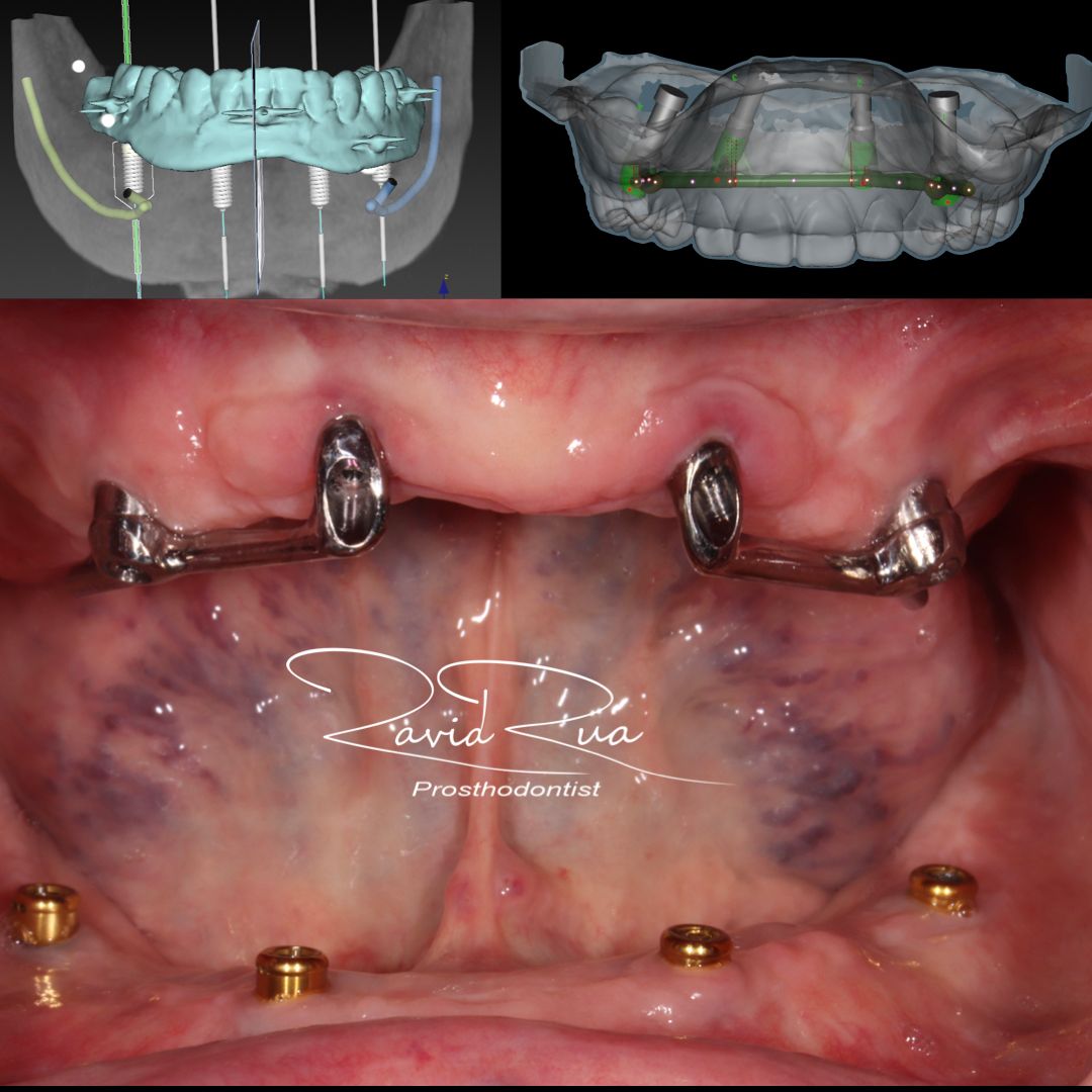 TC Cape Coral Case 16.1 Top and bottom implants overdentures