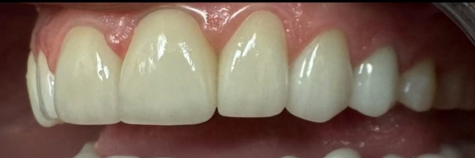 Bright Smiles Marble Falls Case 3 after