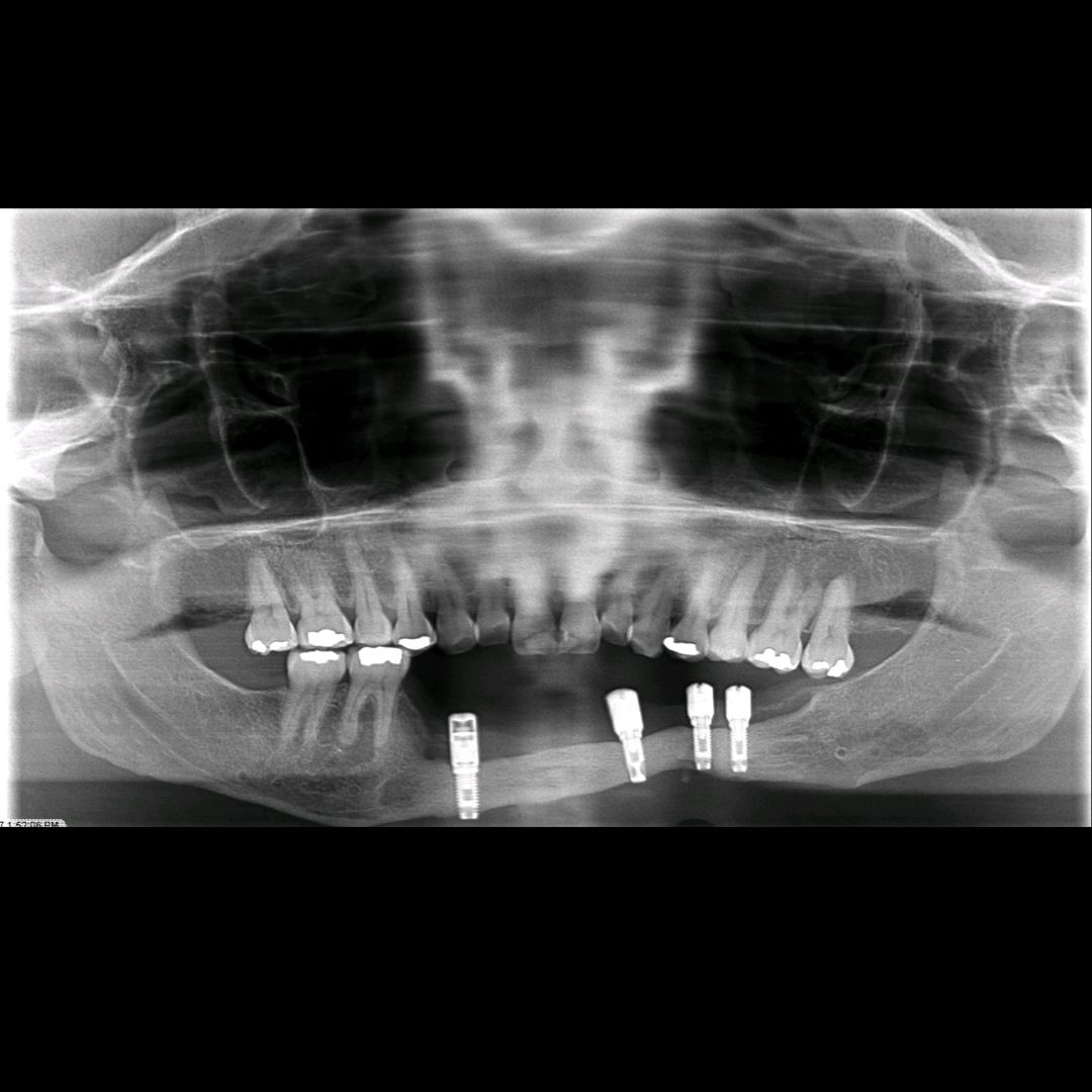 TC Cape Coral Case 10.1 Rib graft and All on 4 Segmental Hybrid for a cancer survival patient