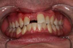 Implants before
