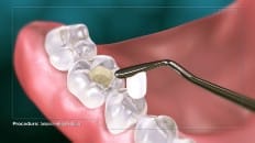 Composite Filling (Posterior) 004