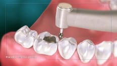 Amalgam Filling (Posterior) 005