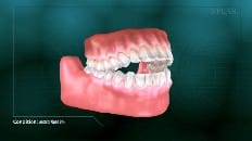 Anterior Open Bite 004