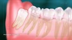 Impacted Third Molar 003