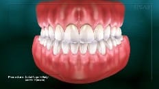 Implant-Supported Bridge 008