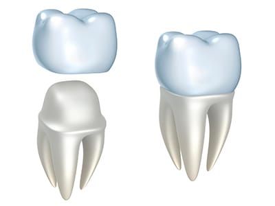 Dental Crowns