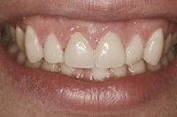 Gum Lengthening after