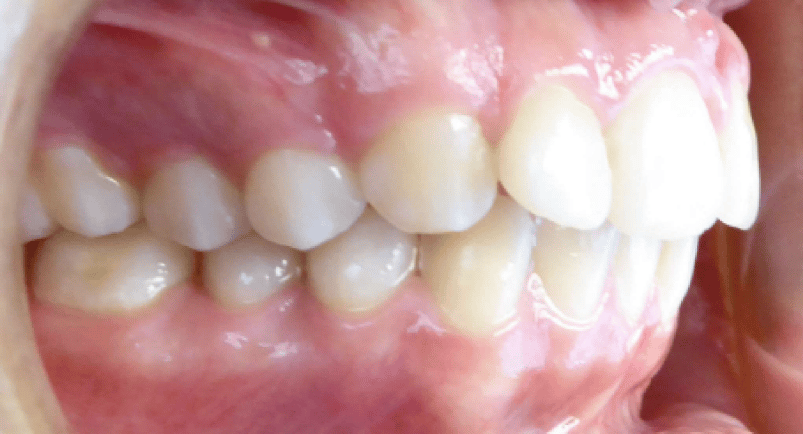 Right Bite for Virtual Orthodontic Consultation