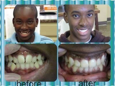 Before and after