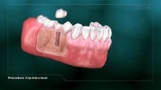 Bridge Versus An Implant 009