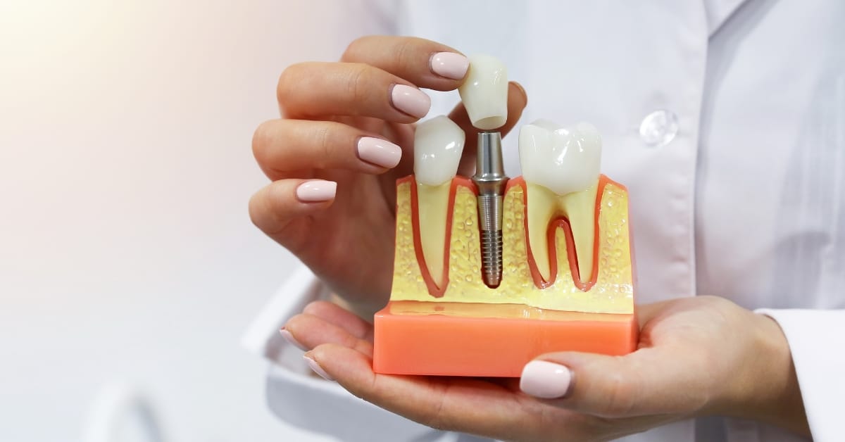 Considering Dental Implants This Summer Blog Image