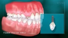 Single Implant (Anterior - Immediate Load) 001
