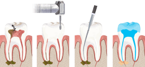 Root Canal