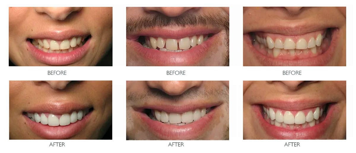 Veneer Before After