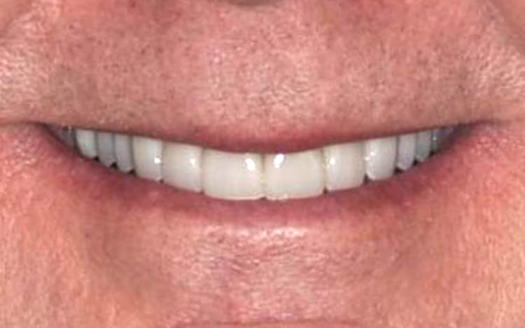 17. Patient MS (10 teeth)_ Porcelain crowns on upper 10 teeth After