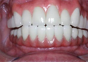 ballston smile gallery case-7-after