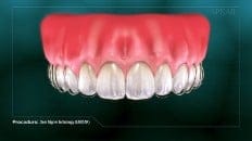 Clear Aligner Technology (Impression) 005