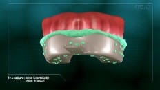 Implant-Supported Bridge 003