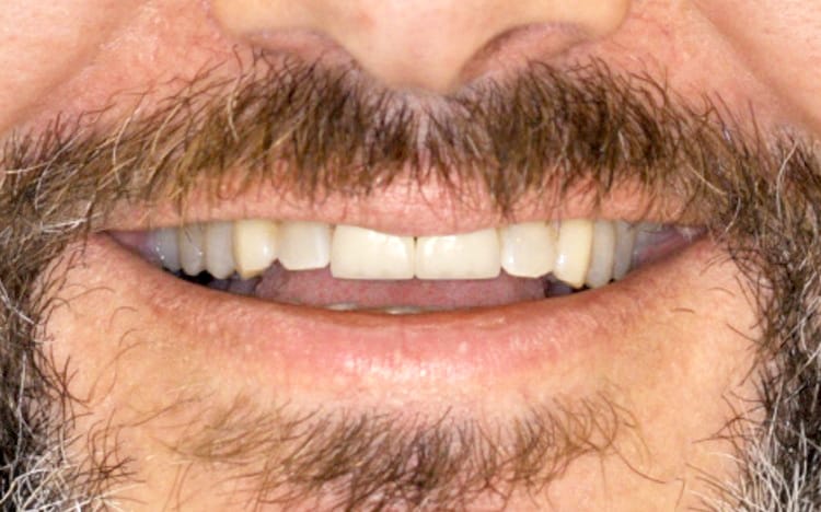 9. Patient SS (6 teeth)_ 6 porcelain crowns on upper front teeth Simulation of 2 front teeth
