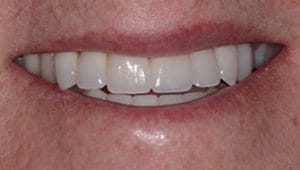 Crowns After