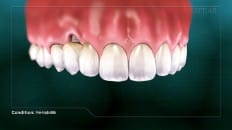 Peri-Implantitis 001