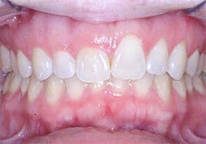 ballston smile gallery case-1-before