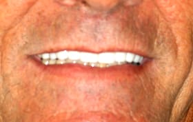 Smile Gallery - after