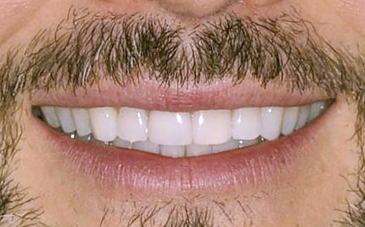 3. Patient MG (1 tooth)_ Single front tooth porcelain crown After