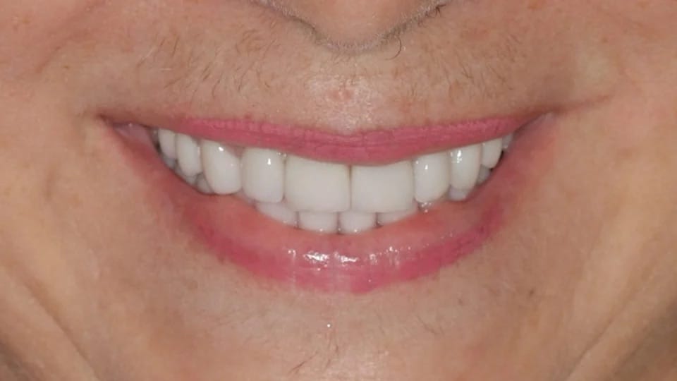 Anastasia Smile 12 after image