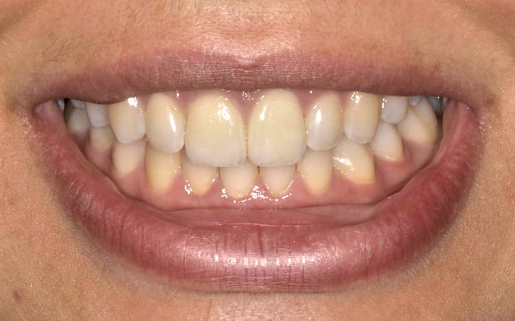4 (1). Patient HM (2 teeth)_ 2 porcelain veneers on front teeth After