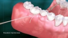 Bridge Versus An Implant 004