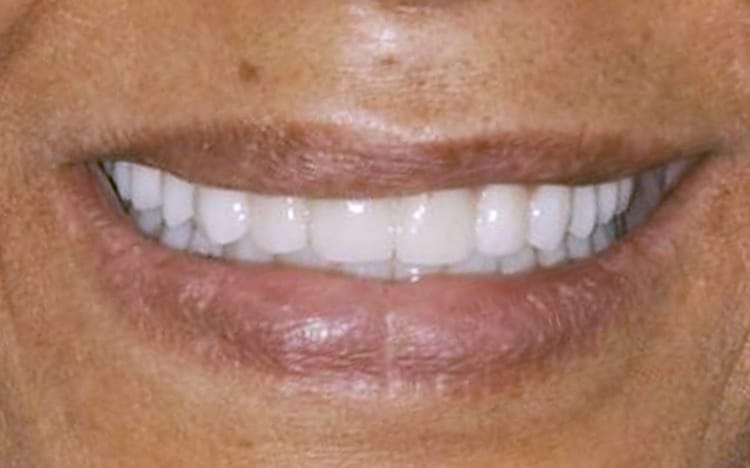 29. Patient KY (complete implant reconstruction upper and lower)_ Maxillary and mandibular hybrid denture prostheses After