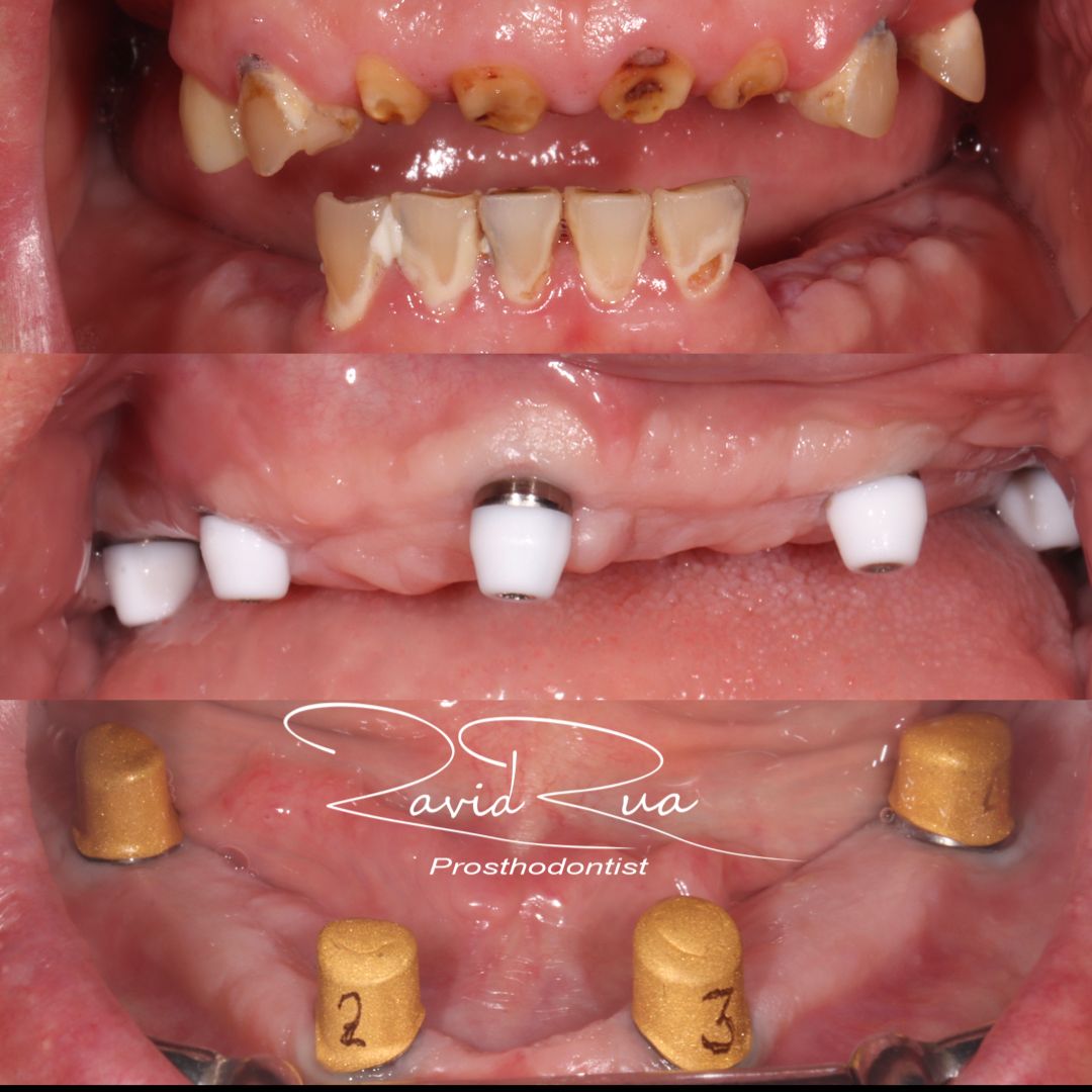 TC Cape Coral Case 7.1 All on 5 implant hybrid and bottom telescopic  restoration