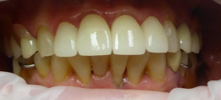 Grapevine After Cosmetic Dentistry 2
