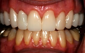 Smile Gallery - after