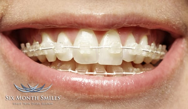 Six month smile
