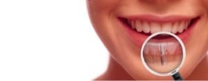 implant in vsi