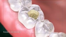 Composite Filling (Posterior) 003