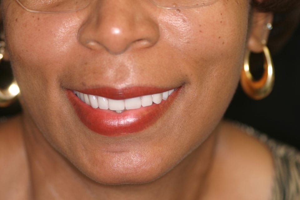 Rasner Smile gallery after 20