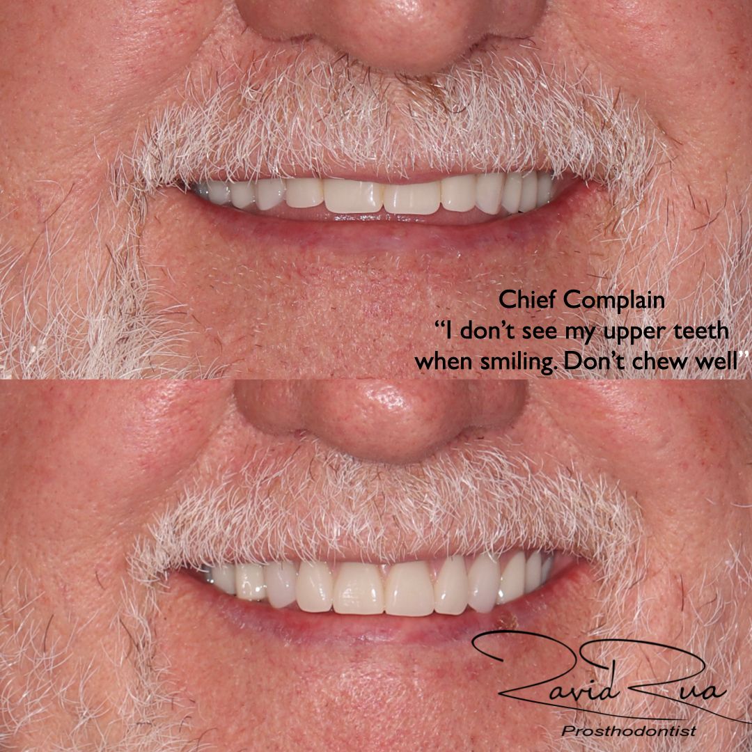 TC Cape Coral Case 17 Top and bottom dentures