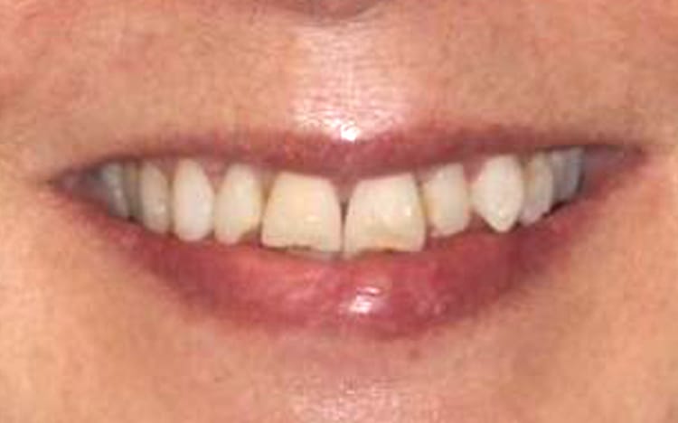 12. Patient LB (8 teeth)_ Mix of porcelain veneers and crowns on upper 8 teeth after trauma. Before