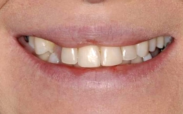 13. Patient AY (9 teeth + 1 implant)_ Mix of porcelain veneers, crowns and implant crown on upper 10 teeth Before