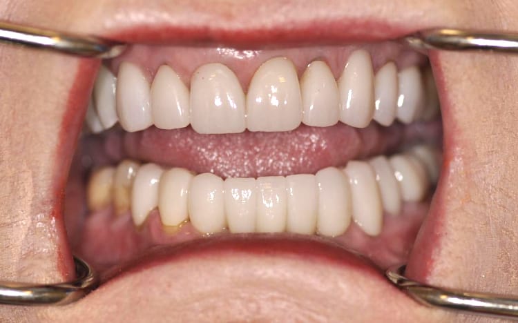 24 (1). Patient ED (18 teeth + 3 implants)_ 8 upper porcelain crowns with 4 porcelain crowns on lower back teeth with and implant supported bridge for lower front 6 teeth After