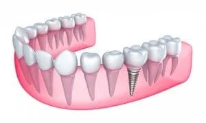 Dental Implants Dental Implants