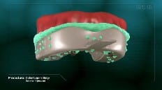 Implant-Supported Bridge 006