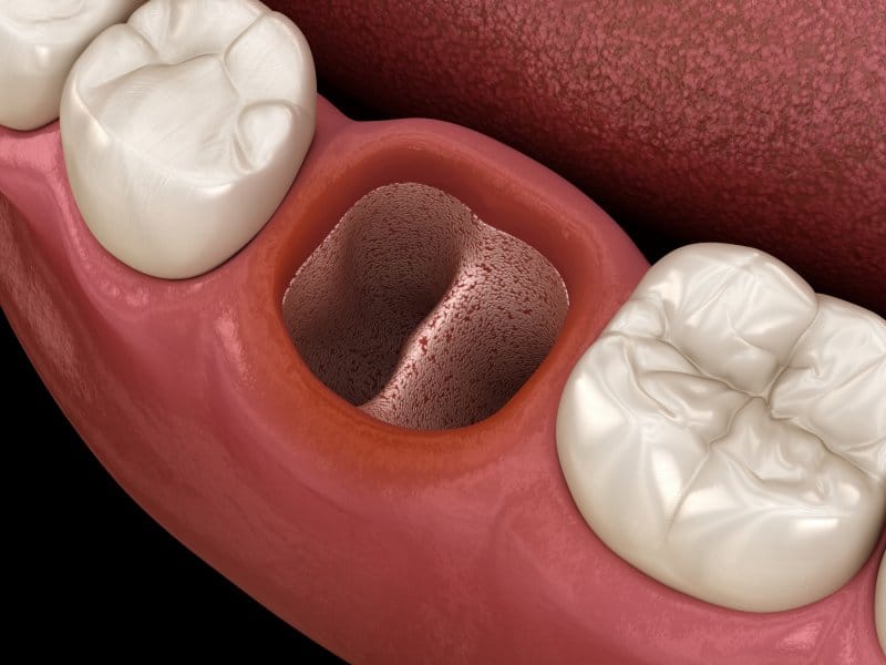 Why is Socket Preservation Important When Receiving Dental Implants Why is Socket Preservation Important When Receiving Dental Implants