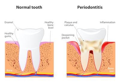 A demonstration of a normal tooth and one with periodontal disease in Pikesville, MD.